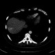 Transient hepatic attenuation difference, liver, THAD: CT - Computed tomography